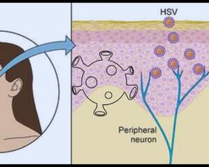 Herpes Simplex Virus