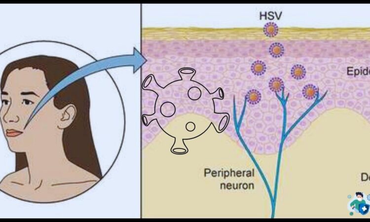 Herpes Simplex Virus