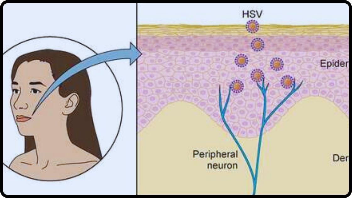 Herpes Simplex Virus